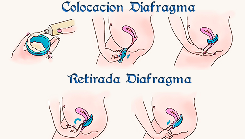 Colocación del diafragma