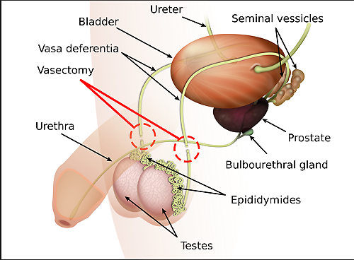 La vasectomía en hombres